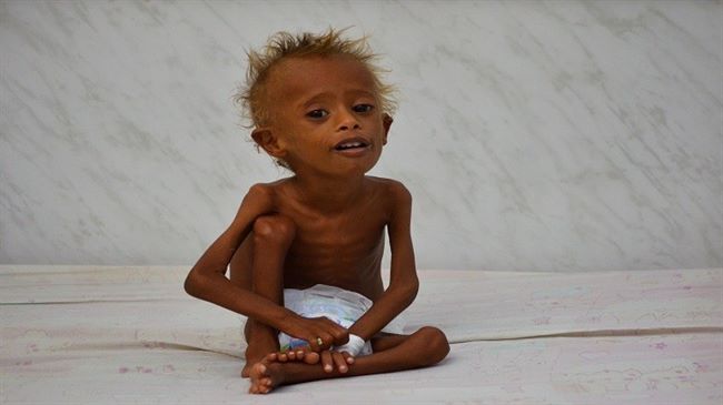 "اليونيسيف": 1.4 مليون طفل يواجهون خطر الموت جوعا