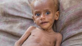 تصريحات أممية جديدة حول كارثة المجاعة باليمن
