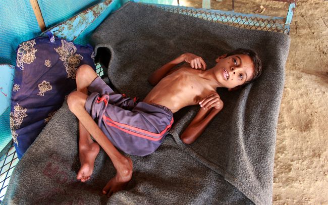 قناة امريكية تكشف جانب من اسوأ الازمات الانسانية والصحية والغذائية الكبرى بسبب الحرب في اليمن